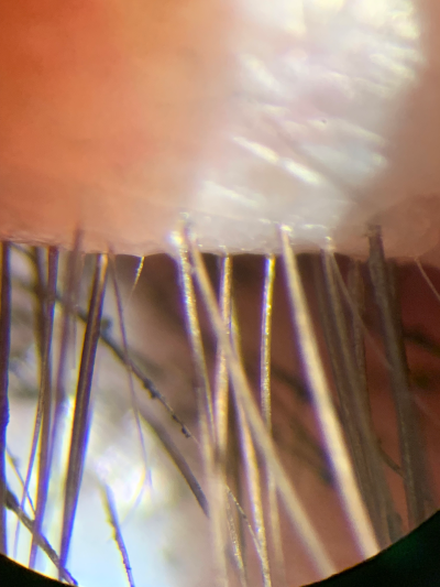 superior lid and lashes, 13 April 2019