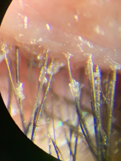 superior lid and lashes, 16 March 2019